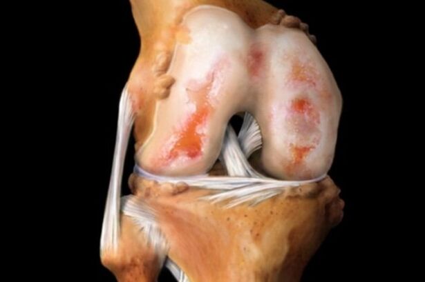 Distruzione dell'articolazione del ginocchio dovuta all'artrosi - una patologia comune del sistema muscolo-scheletrico