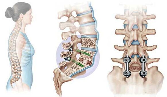 Fissazione delle vertebre spostate con impianti in uno stadio avanzato di osteocondrosi