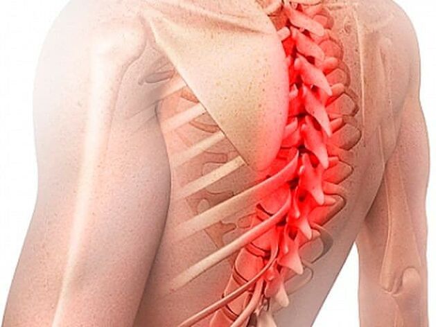 L'osteocondrosi della colonna vertebrale toracica è una forma rara della malattia