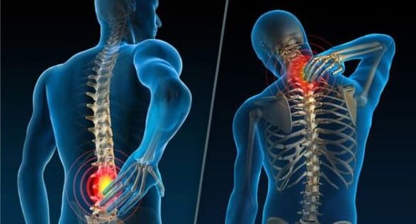 Segni che indicano lo sviluppo dell'osteocondrosi dolore al collo e alla parte bassa della schiena