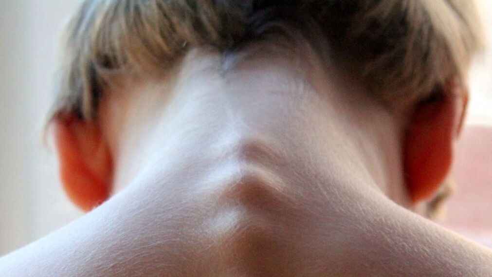 vertebre