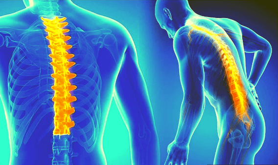 Osteocondrosi della colonna vertebrale