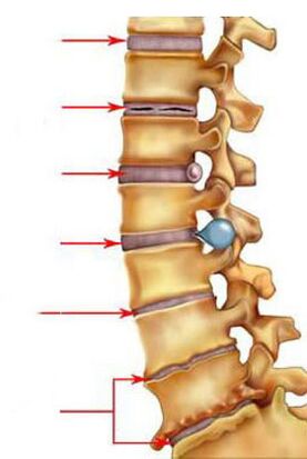 Come si sviluppa l'osteocondrosi