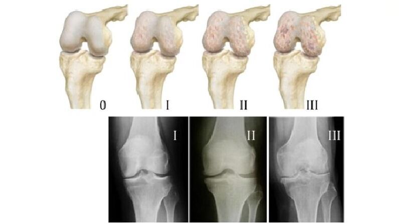 Fasi dell'artrosi dell'articolazione del ginocchio alle radiografie