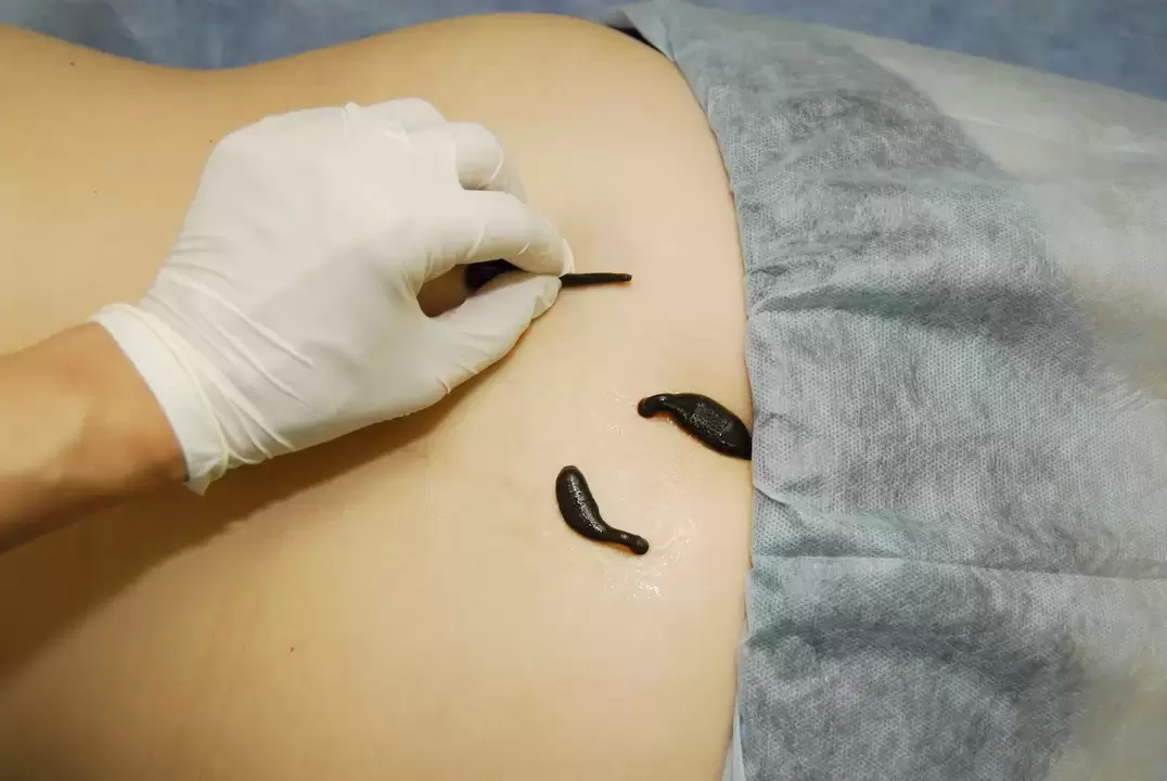 posizionamento di sanguisughe per osteocondrosi lombare