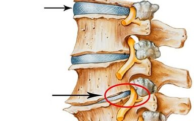 fasi di sviluppo dell'osteocondrosi cervicale