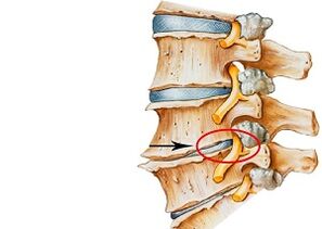 Cause dell'osteocondrosi cervicale