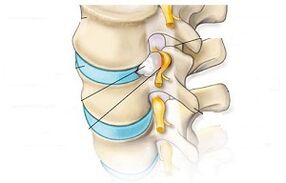 principali sintomi dell'osteocondrosi cervicale