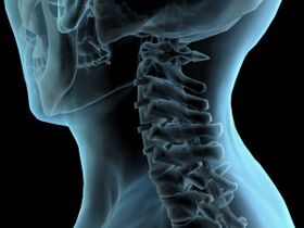vertebre cervicali con osteocondrosi