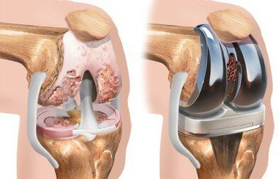 Endoprotesi dell'articolazione del ginocchio con gonartrosi