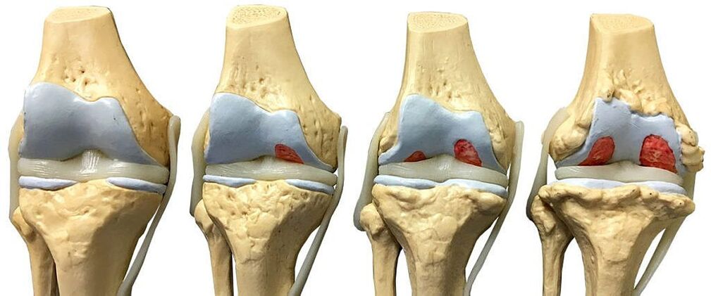 Gradi di artrosi dell'articolazione del ginocchio